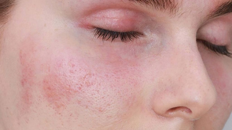 Cấy PRP có bong da không? Cần lưu ý gì khi thực hiện? 2