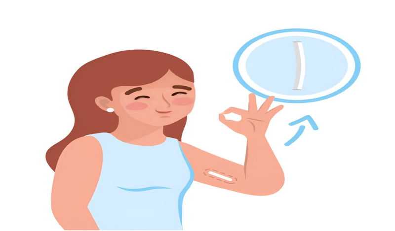 Cấy que tránh thai có an toàn không? Những điều bạn cần biết 2