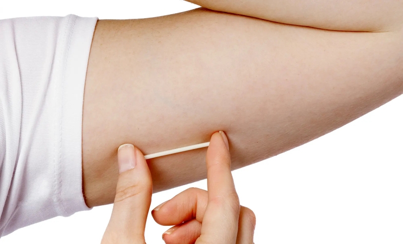 Có nên cấy que tránh thai sau sinh mổ không? Đâu là thời điểm thích hợp 3