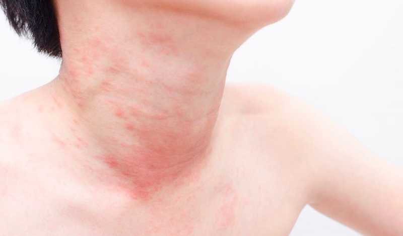 Cây tầm ma là gì? Công dụng chữa bệnh đối với sức khoẻ? 3