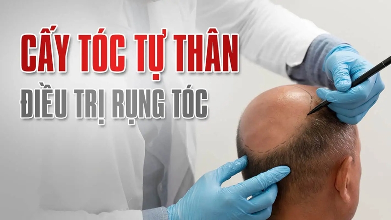 cay-toc-co-hai-khong-nhung-nguy-co-co-the-xay-ra-sau-khi-cay-toc 1.jpg