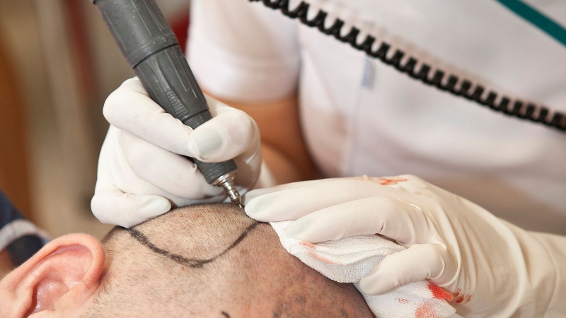 Cấy tóc FUT có ưu nhược điểm gì? Quy trình cấy tóc ra sao? 3