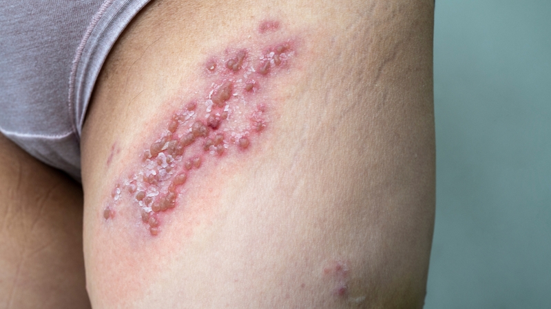 Bệnh Celiac: Nguyên nhân, triệu chứng, phương pháp điều trị 4