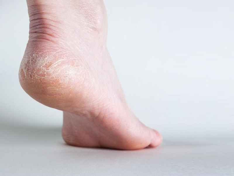 Chà gót chân có tốt không? Vì sao cần chà gót chân?