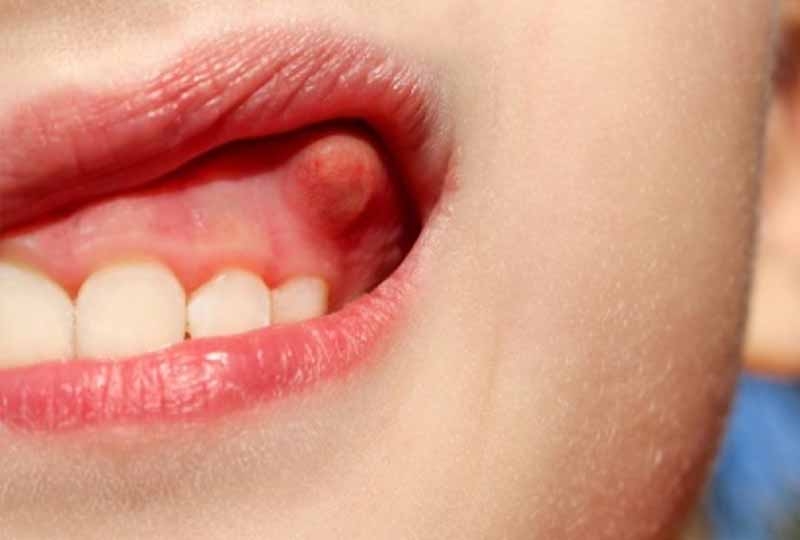 Cha mẹ cần làm gì khi trẻ bị viêm lợi và sốt cao 2