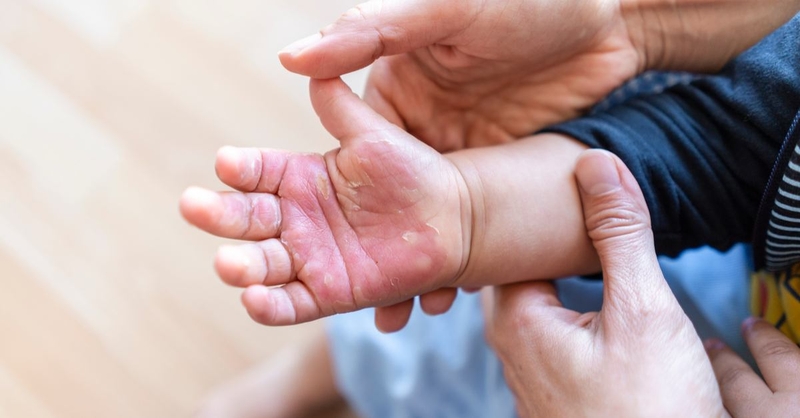 Cha mẹ nên làm gì khi trẻ nhỏ bị bỏng? 1