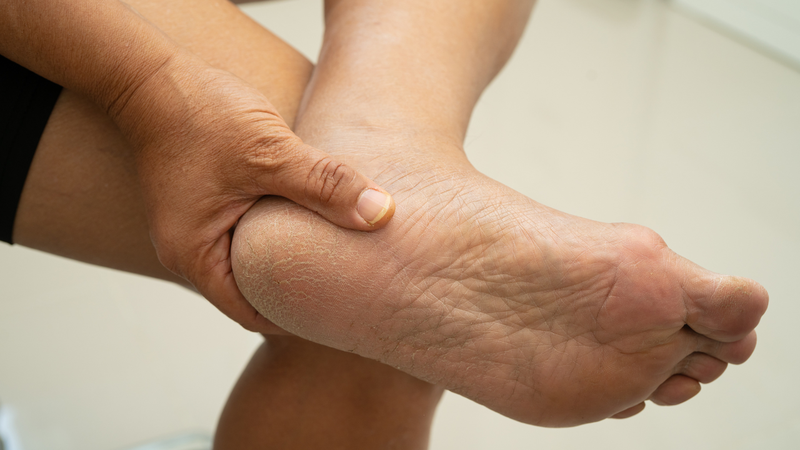 Chai chân là tình trạng lớp da ở bàn chân bị dày lên bất thường