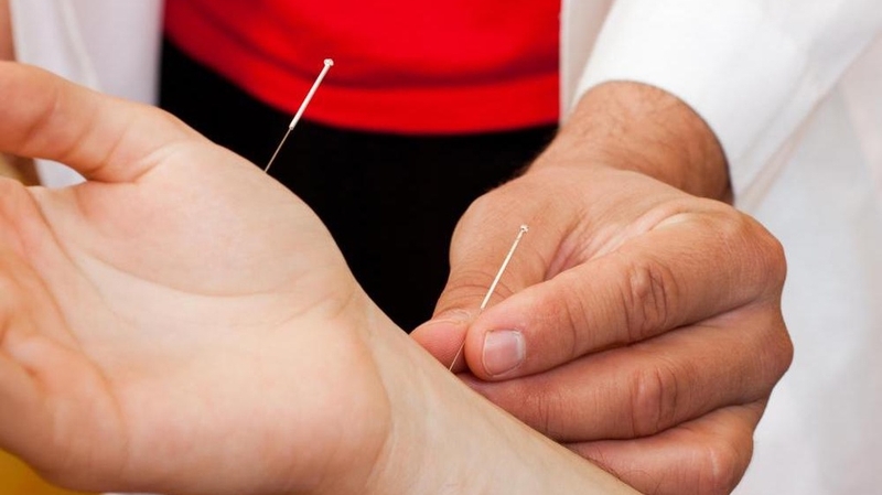 Châm cứu chữa viêm khớp có hiệu quả không? Cách thực hiện 2