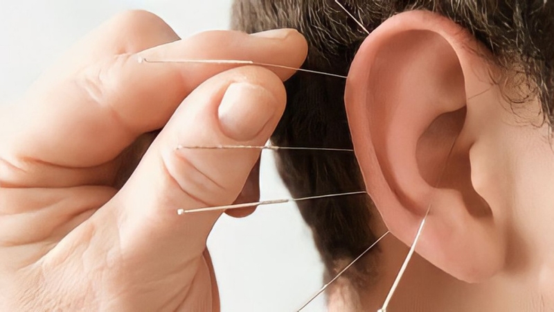 Châm cứu giảm cân và những điều cần lưu ý 3