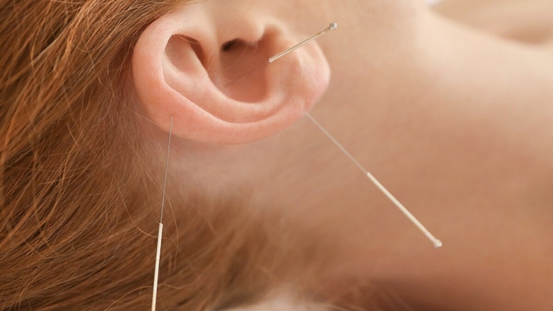 Châm cứu giảm cân và những điều cần lưu ý 2
