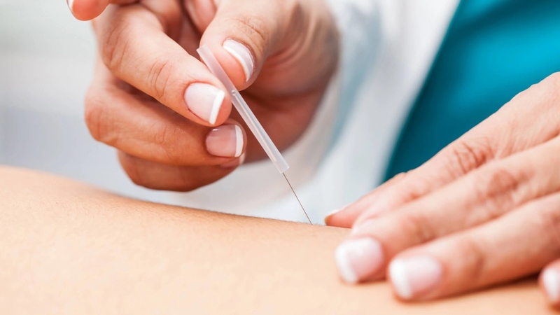 Châm cứu hội chứng ống cổ tay và những điều cần biết 2