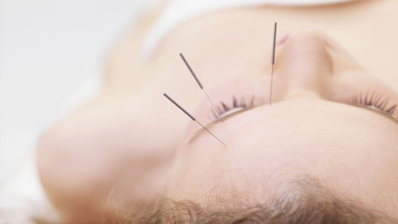 Châm cứu trên khuôn mặt và những điều bạn cần biết 3