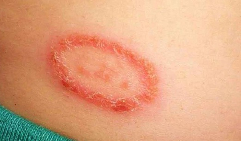 Chàm đồng tiền còn có tên gọi khác là bệnh vảy nến đồng tiền