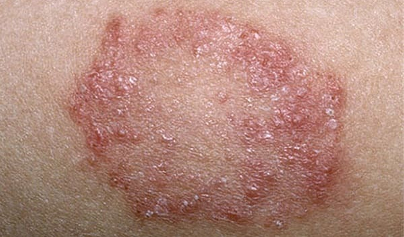 Chàm đồng tiền có lây không?