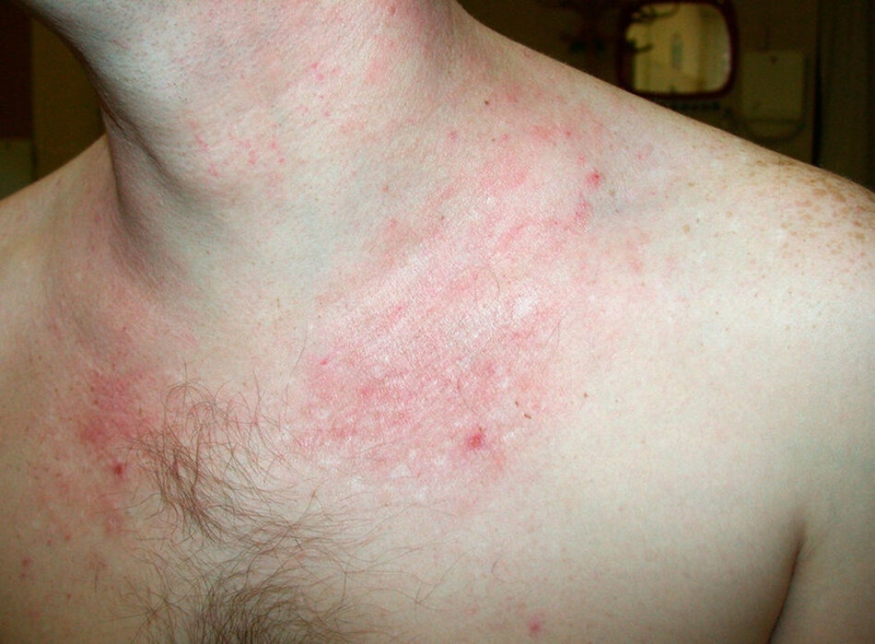 Dấu hiệu đầu tiên của bệnh lý này chính là một nhóm các nốt hoặc vết sưng nhỏ trên da.