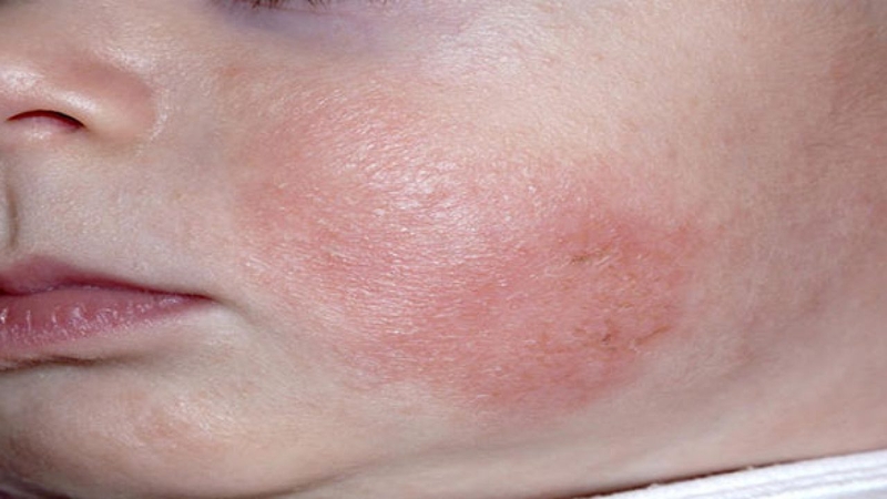 Một số cách phòng tránh chàm đồng tiền ở trẻ