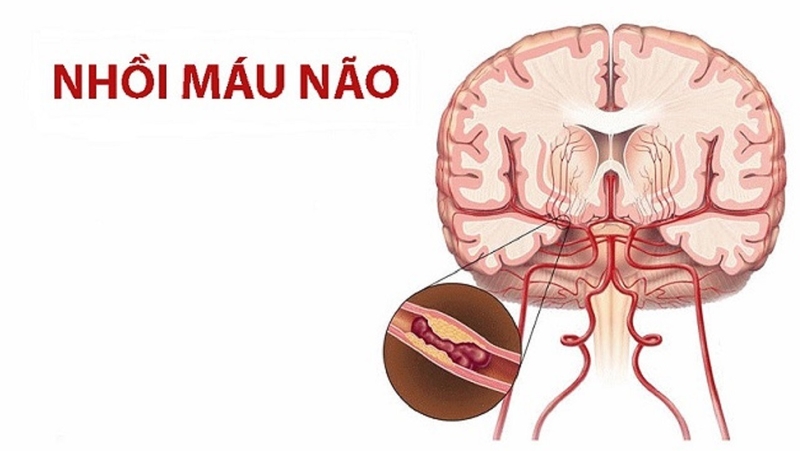 Chăm sóc bệnh nhân nhồi máu não sau điều trị 1