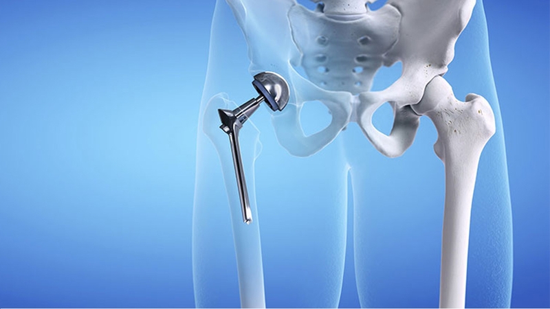 Chăm sóc bệnh nhân sau phẫu thuật thay khớp háng như thế nào? 1