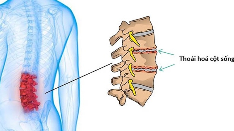 Cách chăm sóc bệnh nhân thoái hóa cột sống thắt lưng sớm cải thiện bệnh?