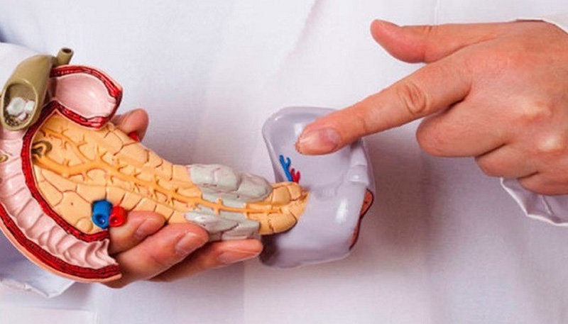 Ung thư tụy giai đoạn cuối sống được vao lâu phụ thuộc vào việc chuẩn đoán và điều trị