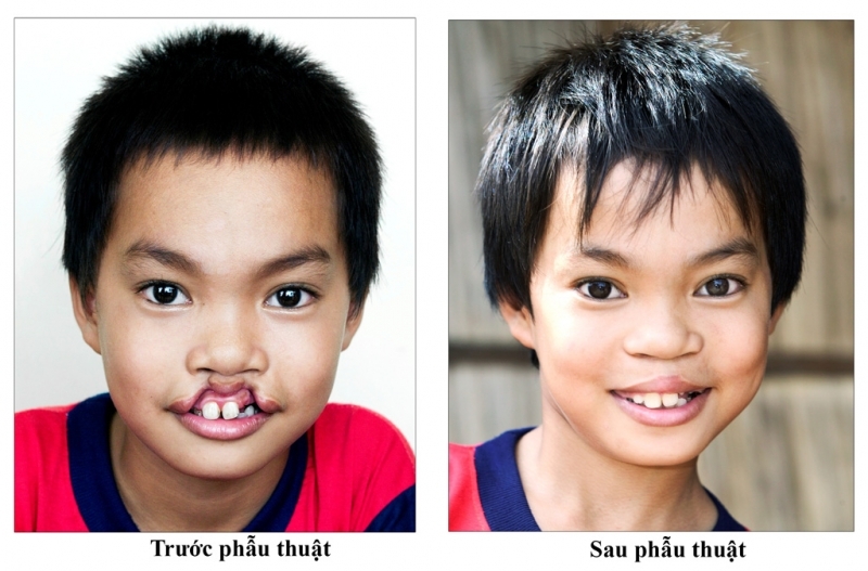 Chăm sóc bệnh nhi sau phẫu thuật hở hàm ếch đúng cách 1