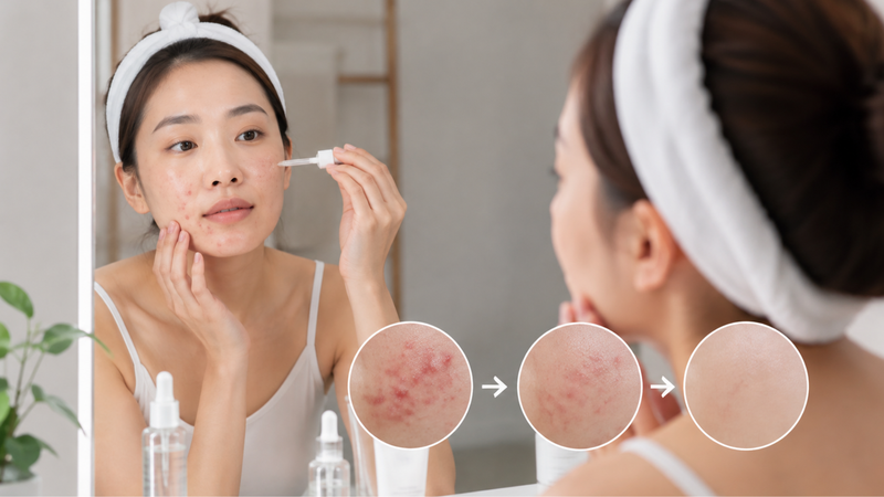 Da cần thời gian thích nghi khi bắt đầu sử dụng hoạt chất trị mụn mới