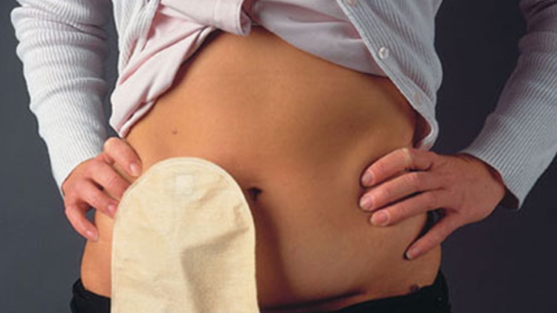 Chăm sóc hậu môn nhân tạo đúng cách, bạn đã biết chưa? 3