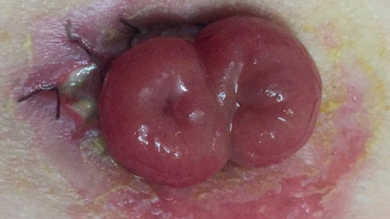 Chăm sóc hậu môn nhân tạo đúng cách, bạn đã biết chưa? 1