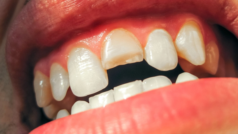Chăm sóc răng bị gãy như thế nào? Cách phục hồi răng khoa học 1