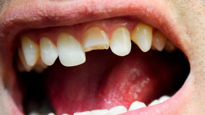 Chăm sóc răng bị gãy như thế nào? Cách phục hồi răng khoa học 1