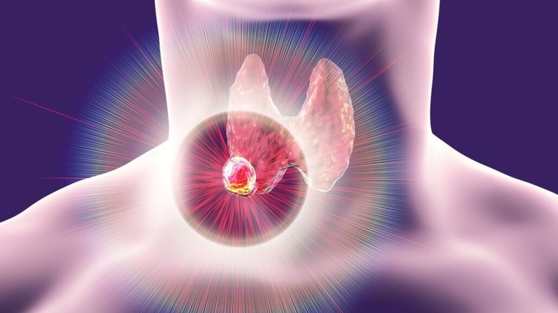 chăm sóc sau phẫu thuật ung thư tuyến giáp cần lưu ý gì 1