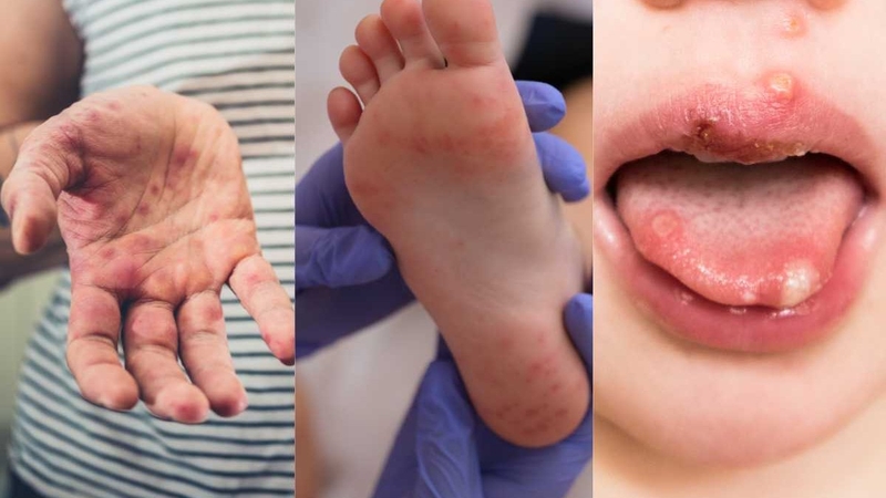 Các nốt mụn nước xuất hiện ở tay, chân và miệng