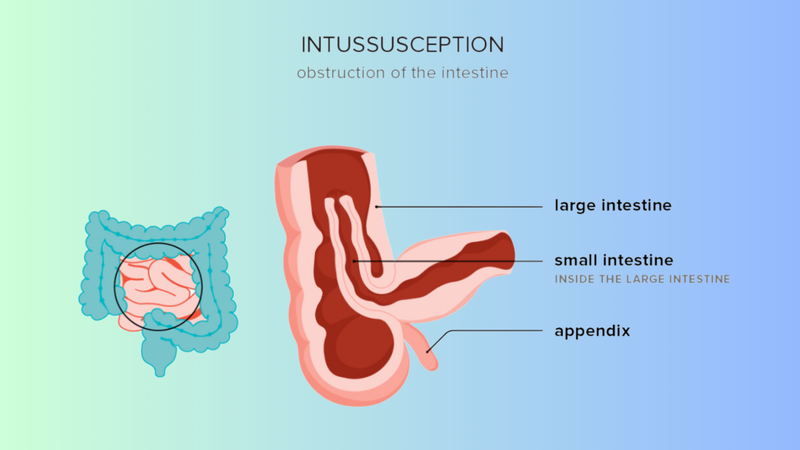 Chăm sóc trẻ sau điều trị lồng ruột cần chú ý những gì? 1