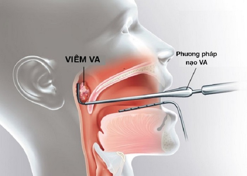Chăm sóc trẻ sau nạo VA như thế nào 1