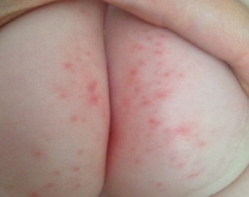 Vùng da ở mông rất ít được tiếp xúc với&nbsp;không khí và ánh sáng nên dễ bị rôm sảy