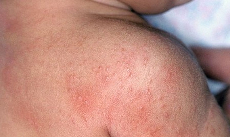 Rôm sảy có thể khiến trẻ thường xuyên bỏ ăn, ngủ không ngon giấc&nbsp;và tụt cân