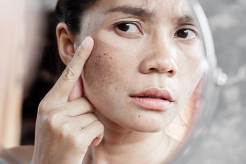 Chăm sóc và điều trị nám da cho phụ nữ ở độ tuổi 40