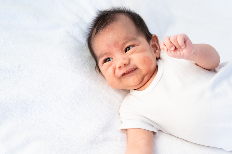 Dấu hiệu nhận biết chàm đỏ ở trẻ sơ sinh và hướng xử lý 1