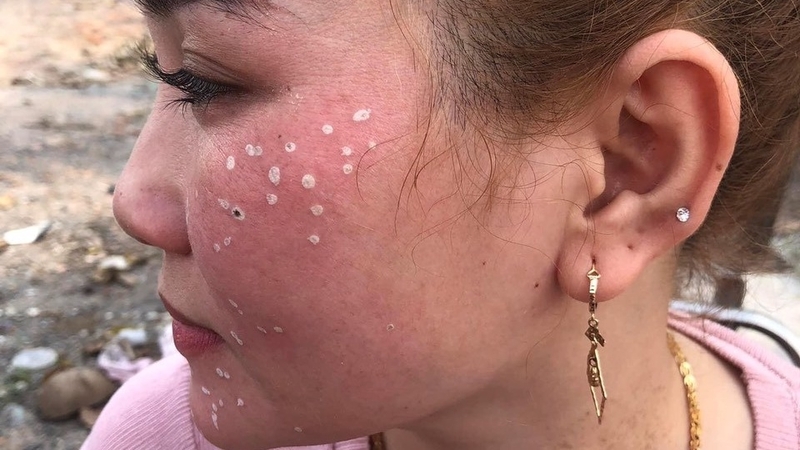 Chấm tàn nhang kiêng nước bao lâu 2