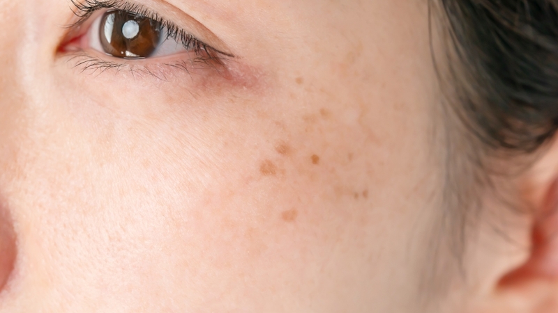 Chấm tàn nhang kiêng nước bao lâu 4