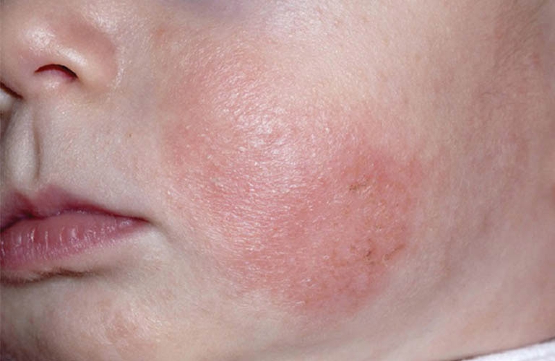 Chàm thể tạng là gì? Nguyên nhân và cách điều trị chàm thể tạng 3