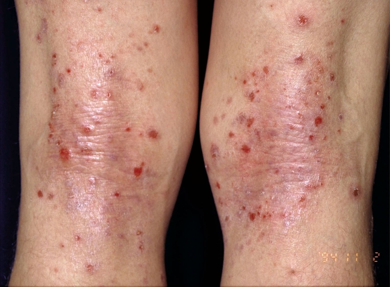 Chàm tổ đỉa chân: Nguyên nhân, triệu chứng và cách khắc phục tại nhà 3