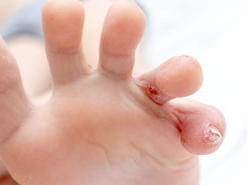 Chàm tổ đỉa lòng bàn chân có nguy hiểm không? 1