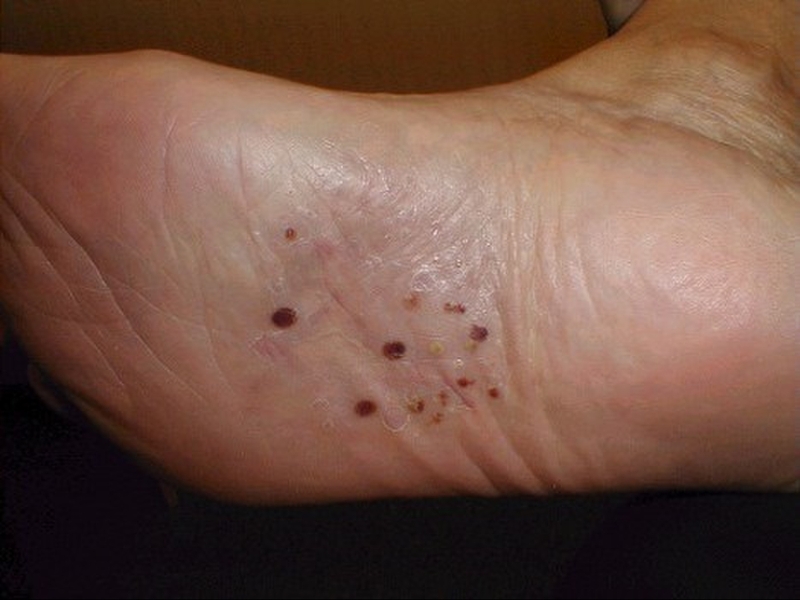 Chàm tổ đỉa lòng bàn chân có nguy hiểm không? 2