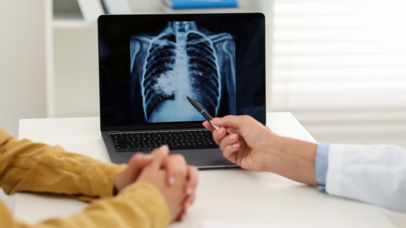 Bệnh lao chưa được điều trị có nguy cơ lây nhiễm cao