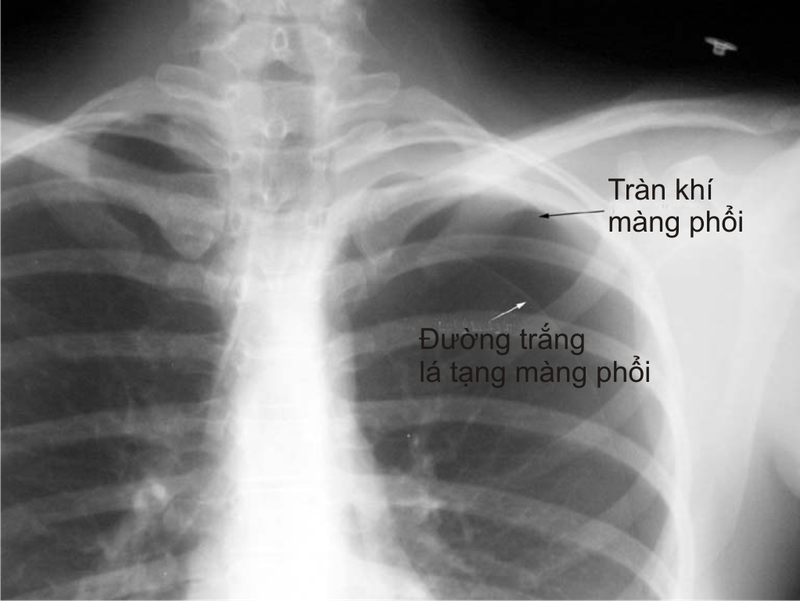 Chẩn đoán bệnh qua hình ảnh tràn khí màng phổi 2