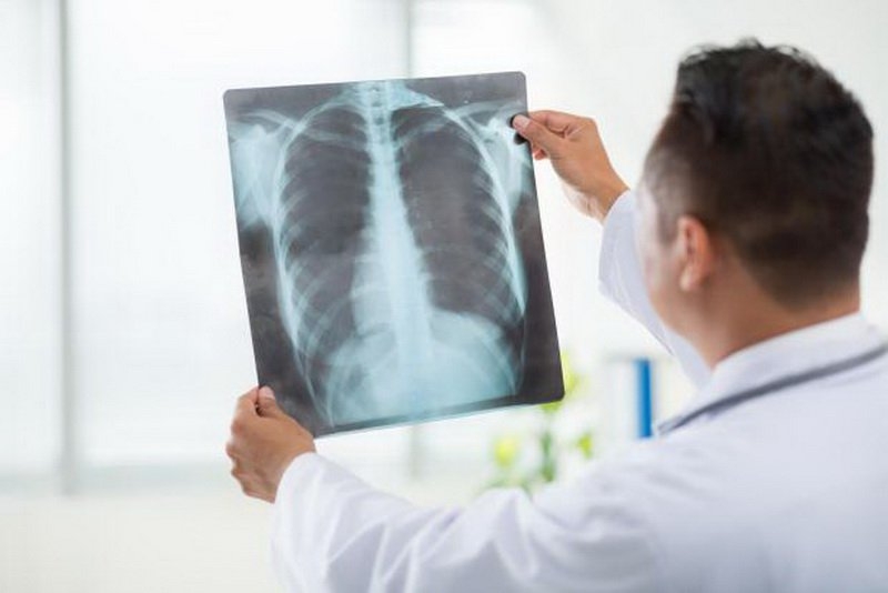 Chẩn đoán bệnh qua hình ảnh tràn khí màng phổi 3