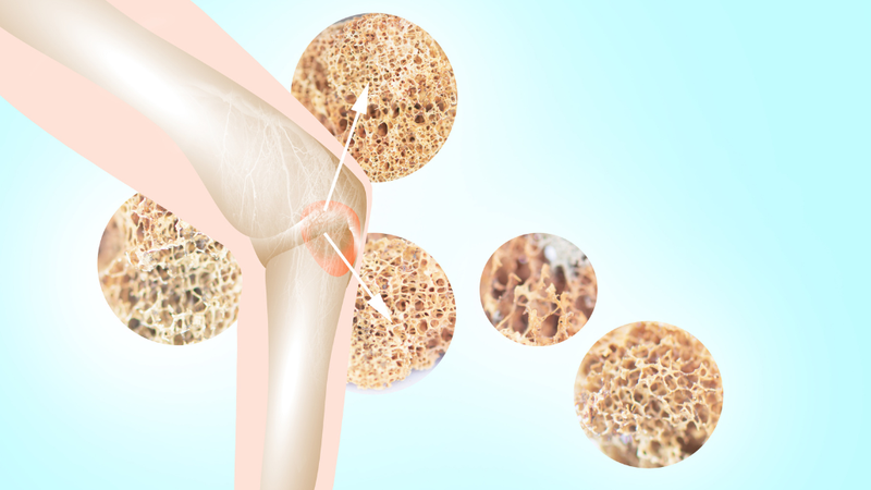 chan-doan-loang-xuong-va-dau-hieu-nhan-biet-loang-xuong 3