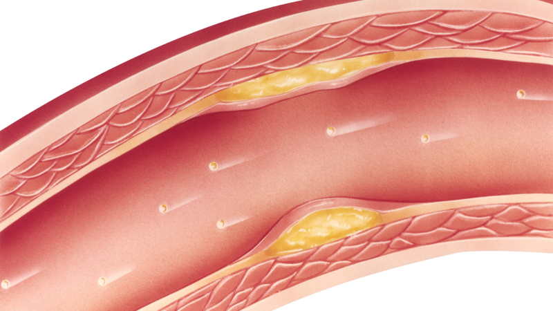 chan-doan-roi-loan-lipid-mau-nhu-the-nao 2