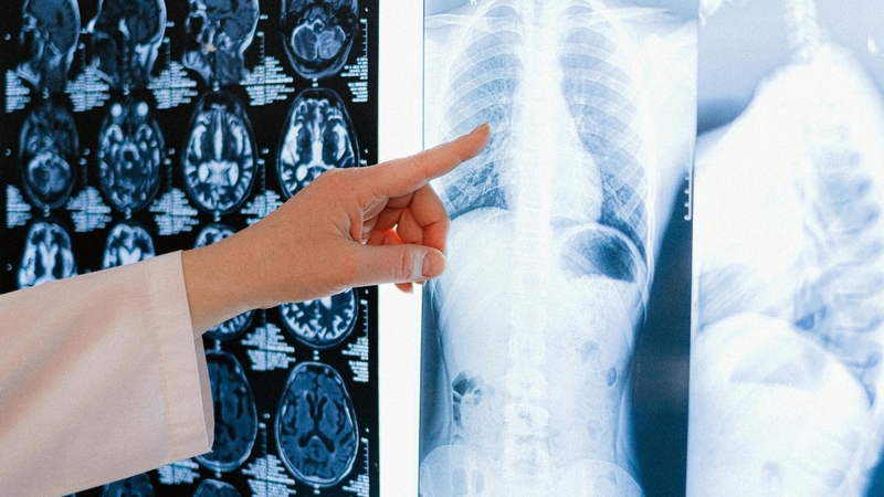 X-quang ngực hỗ trợ tìm nguyên nhân gây suy hô hấp